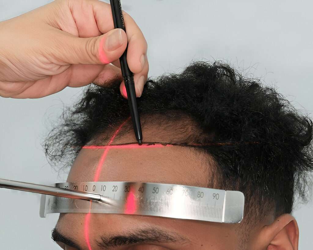 hair transplant UK