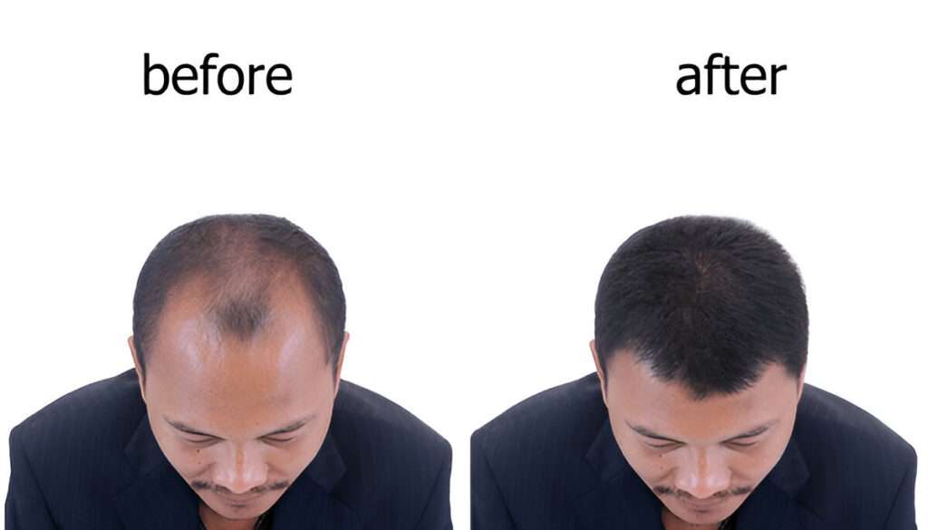 Hair Transplant