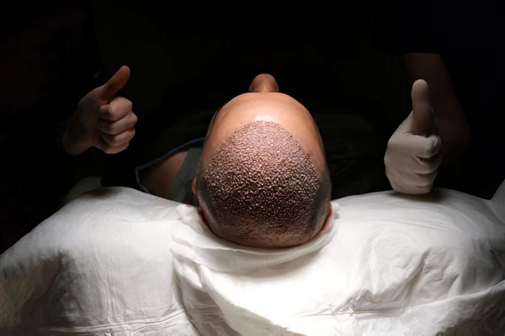 Hair Transplant