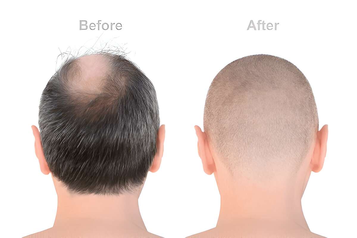 London hair transplant