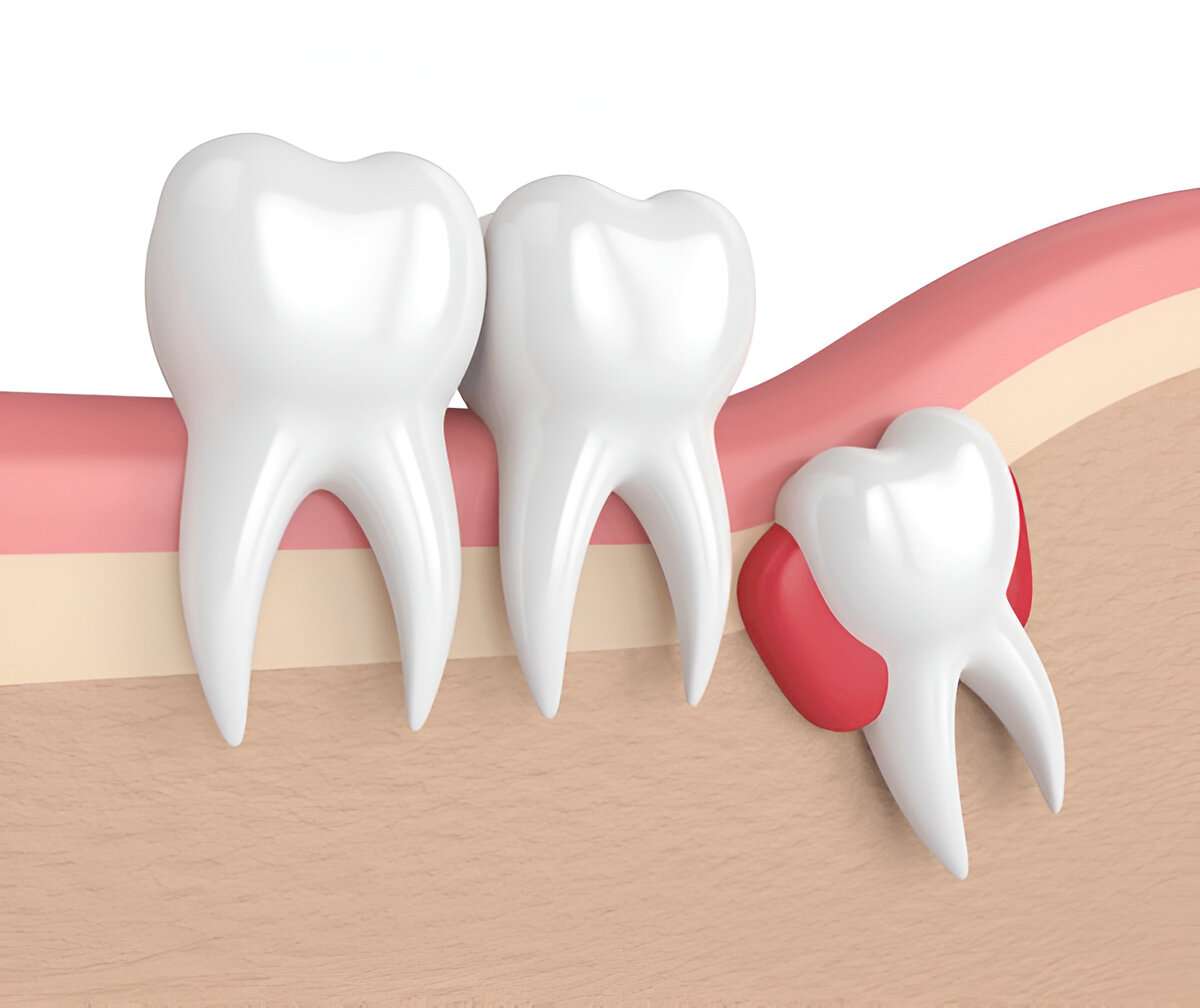 wisdom teeth surgery