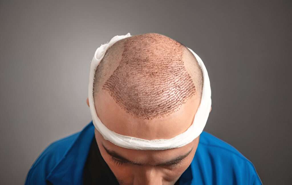 hair transplant Manchester