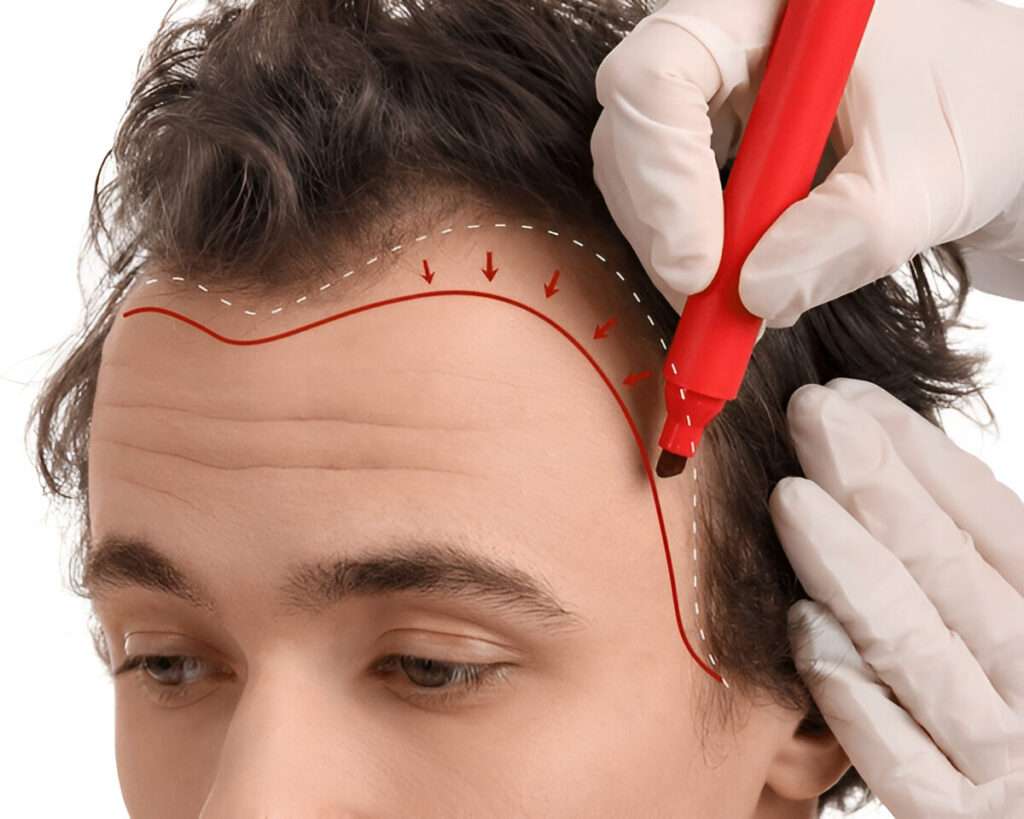 hair transplant UK