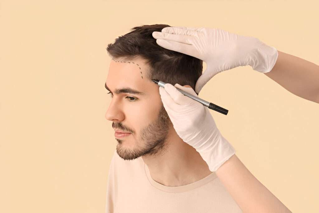 hair transplant Bristol
