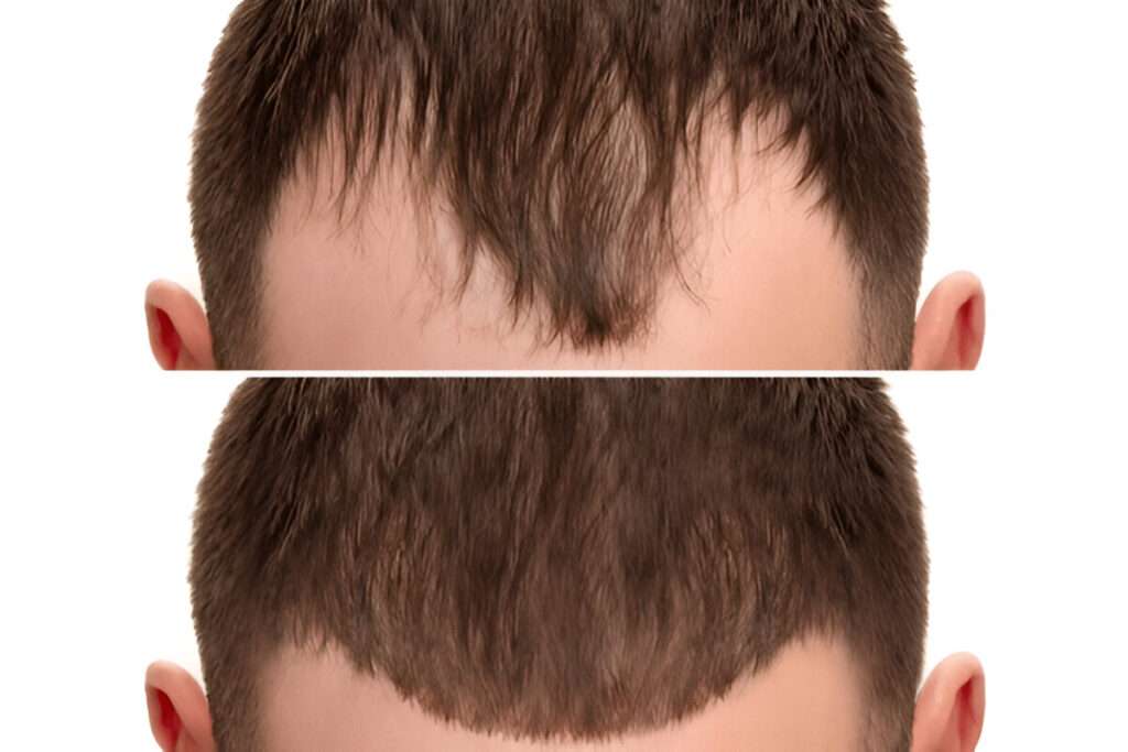 hair transplant Cardiff