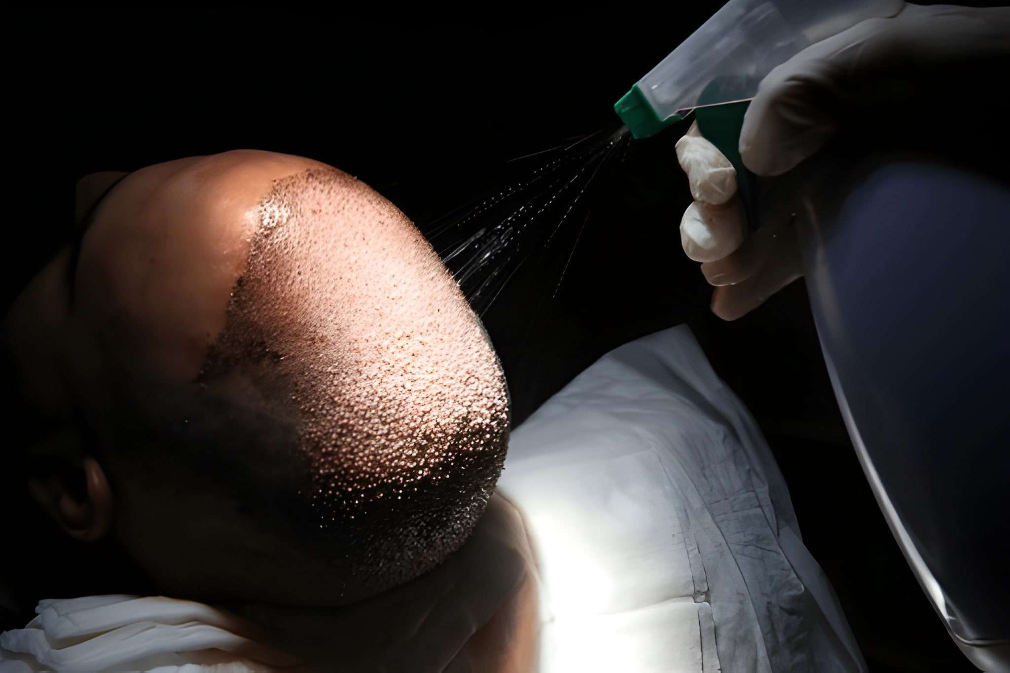 Hair Transplant